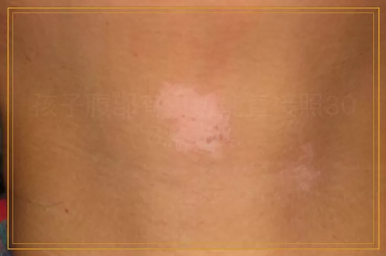 孩子腹部有白斑能直接照308激光吗