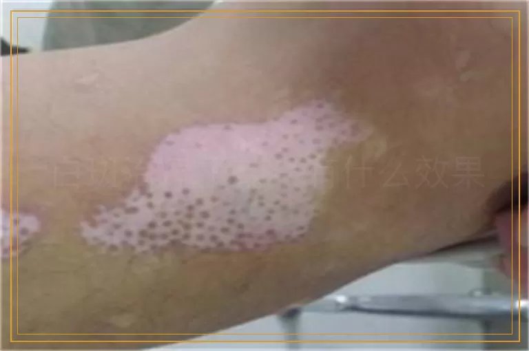 白斑治疗了却没有什么效果