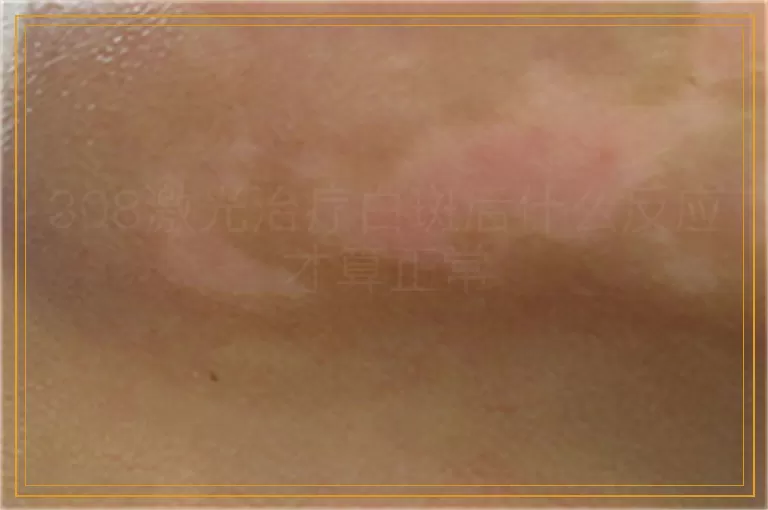 308激光治疗白斑后什么反应才算正常