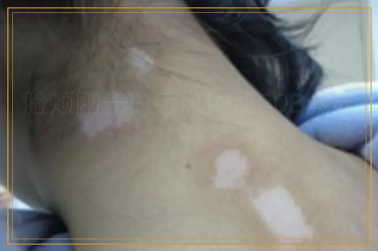 脸颊刚长白癜风能照308激光吗