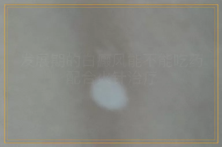 发展期的白癜风能不能吃药配合火针治疗