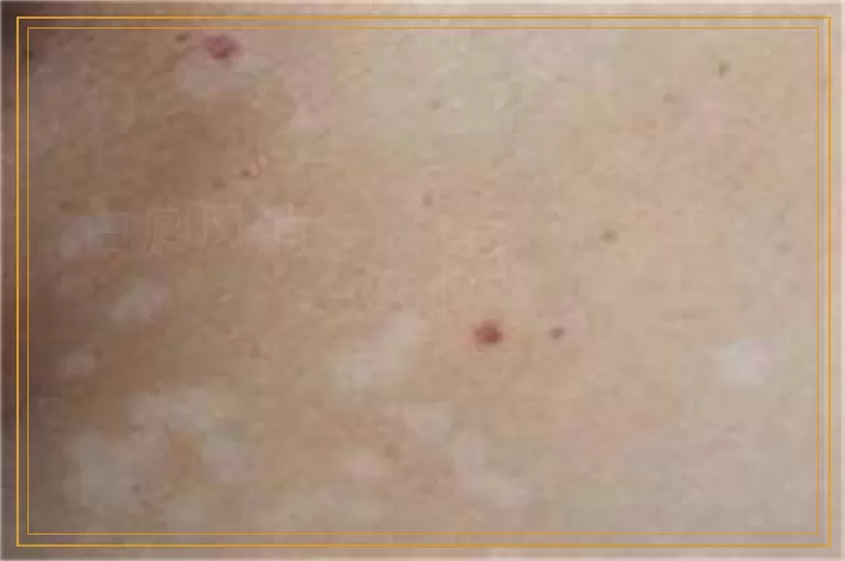 白癜风消失后春天还用再吃药吗