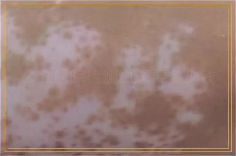 公立医院检测白斑要多少钱