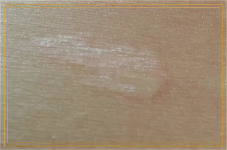 住院治疗白癜风大概需要多少钱