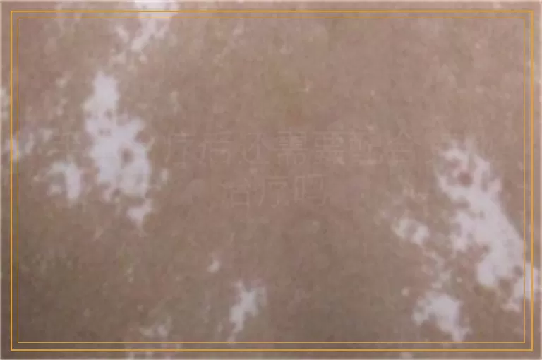 手术治疗后还需要配合其他治疗吗
