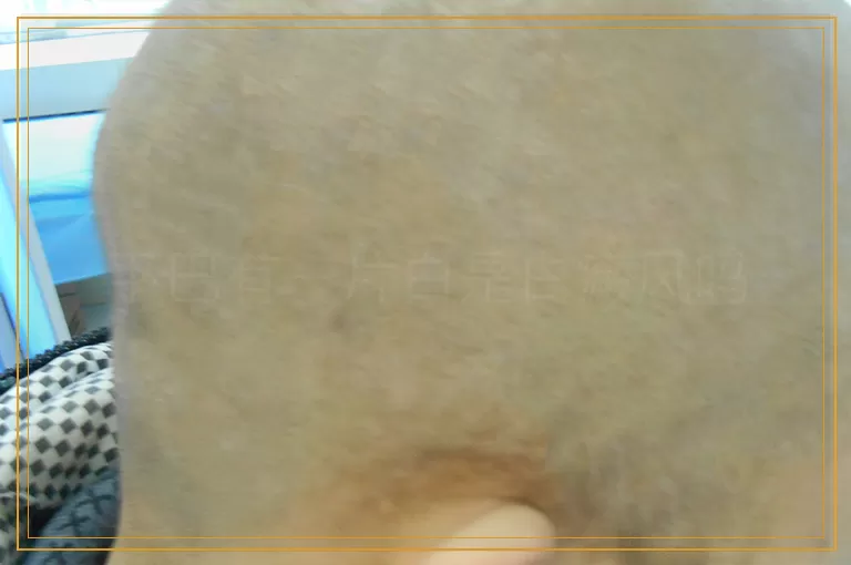下巴有一片白是白癜风吗