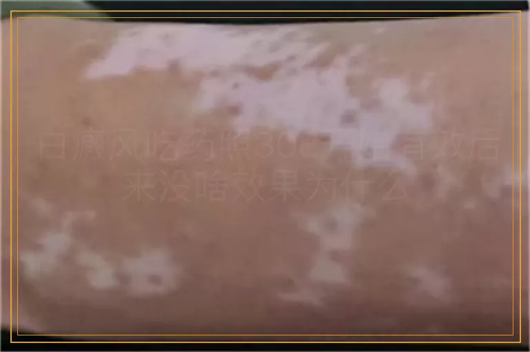 白癜风吃药照308开始有效后来没啥效果为什么