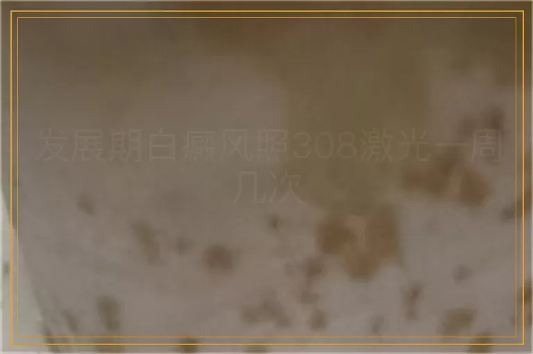 发展期白癜风照308激光一周几次