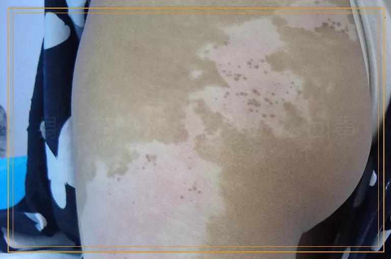 身上有一块块白是怎么回事