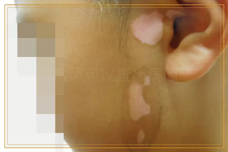 白癜风可以查出病因吗