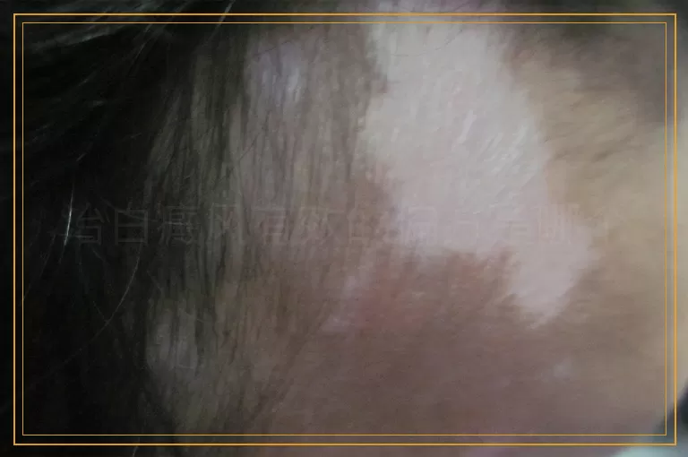 治白癜风有效的偏方是哪个