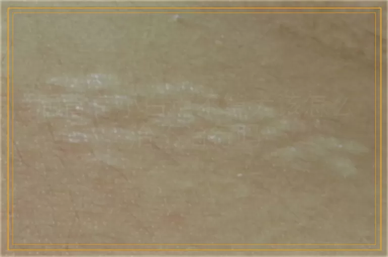 后背有小白点不算大该怎么治不治行吗