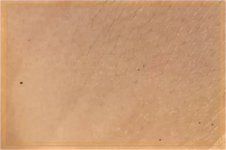 白癜风吃药两月还有新的皮损是药不管用吗