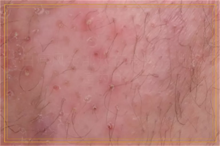 白癜风全部长在身体右侧这是为什么