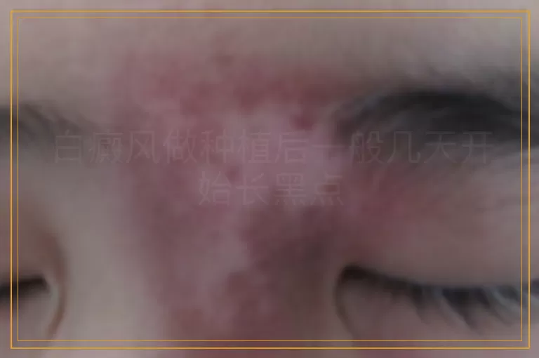 白癜风做种植后一般几天开始长黑点