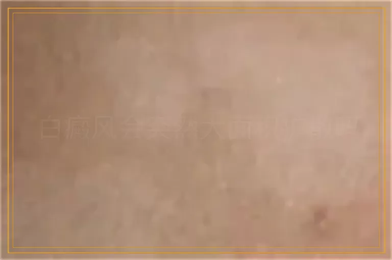 白癜风会突然大面积扩散吗