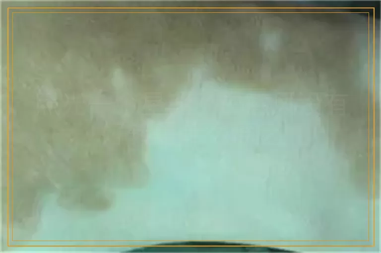 照光一个星期了白癜风没有好转是什么原因