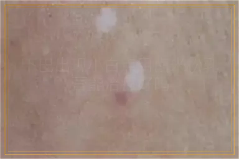 下巴出现小白点用卤米松乳膏能治疗好吗