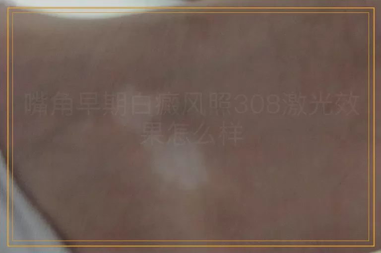 嘴角早期白癜风照308激光效果怎么样