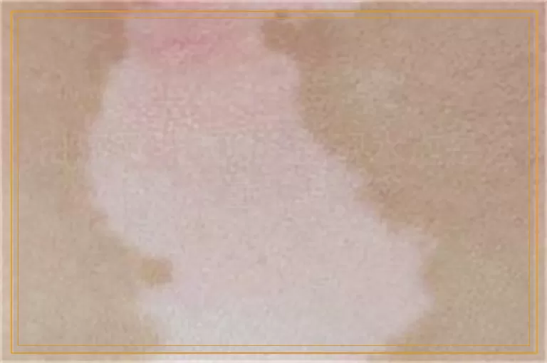 白癜风照308光出现水泡是过量了吗