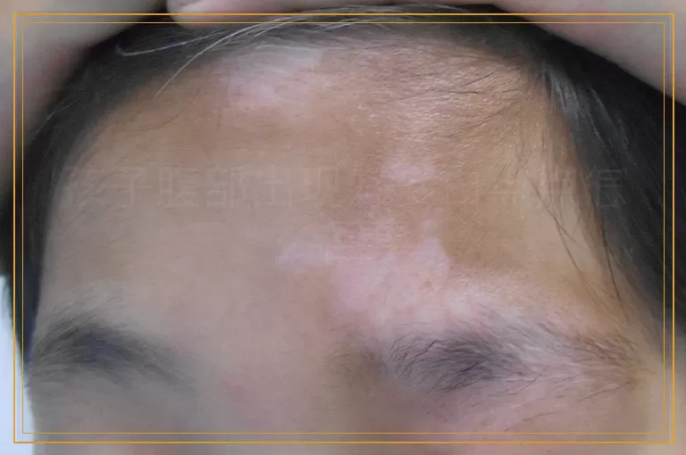 孩子腹部出现好多白点点怎么回事