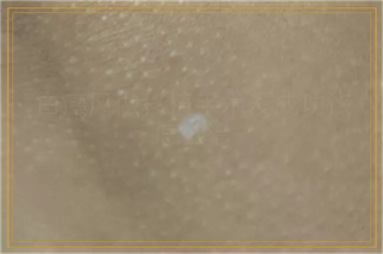 白癜风做移植手术没成功该怎么治