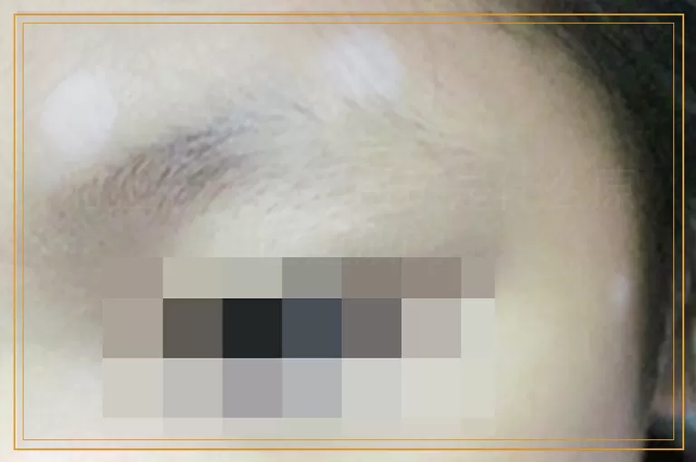 脸上长大面积白斑是什么原因造成的