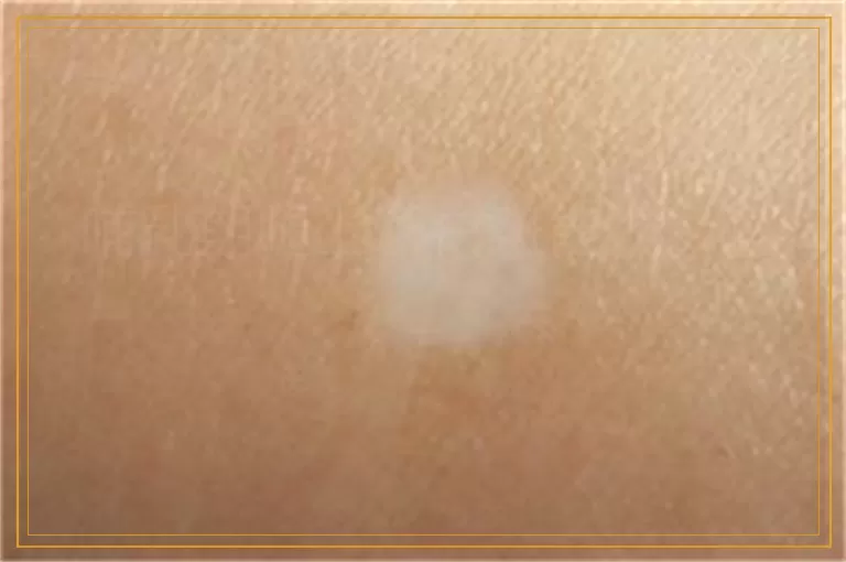 哺乳期腿上长白斑能做ct吗