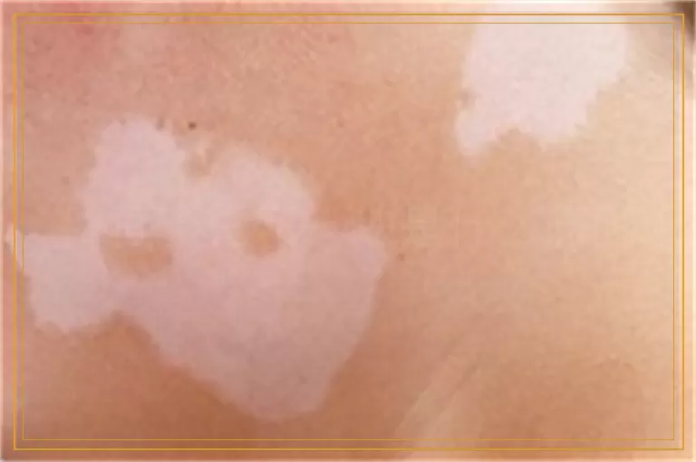 脚面上白了一块是什么原因