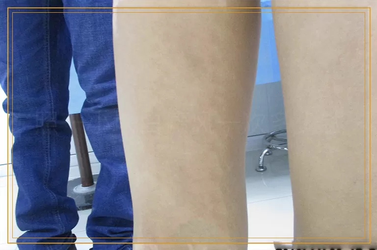 照一小块白癜风一次多少钱