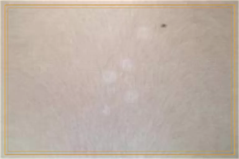 伍德灯检查纯白无荧光还是白癜风吗