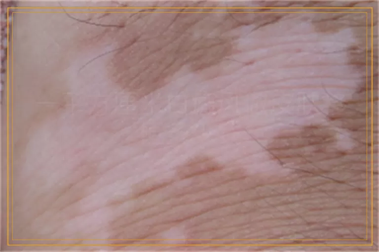 一平方厘米白癜风做皮肤移植多少钱