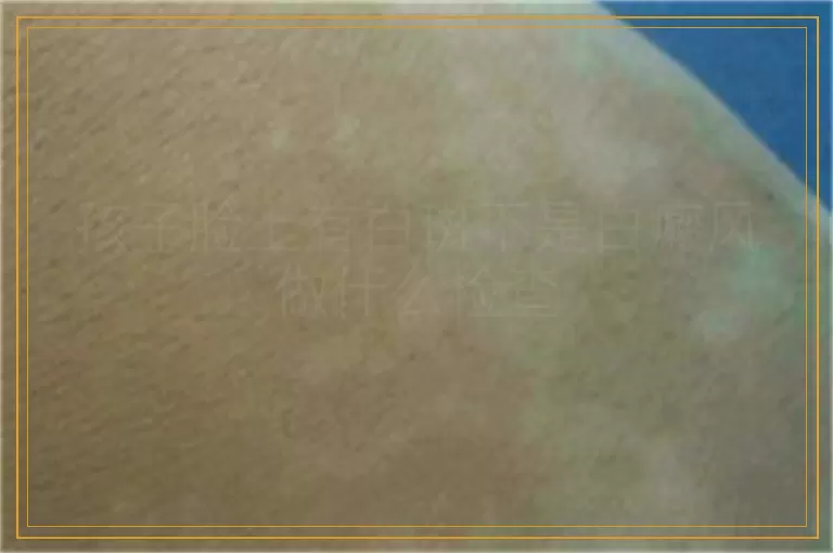 孩子脸上有白斑不是白癜风做什么检查