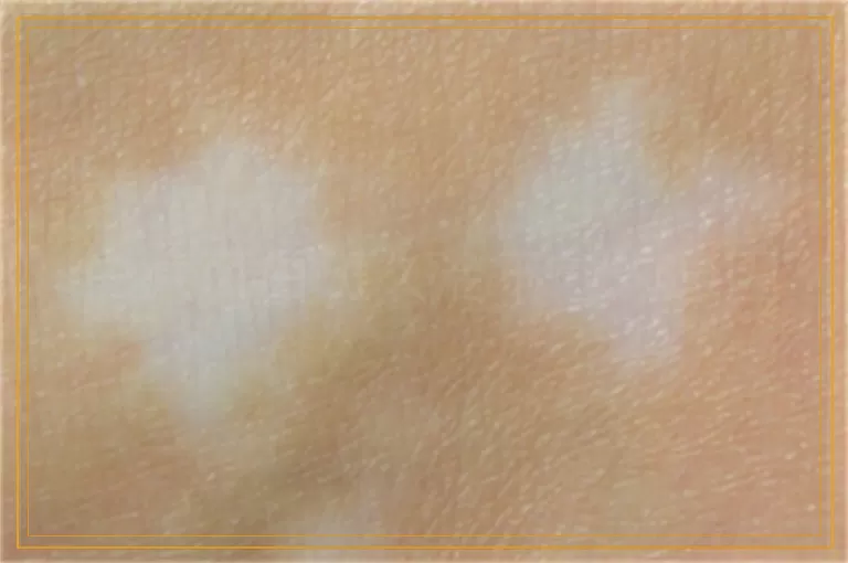 白癜风白斑久治不愈的原因