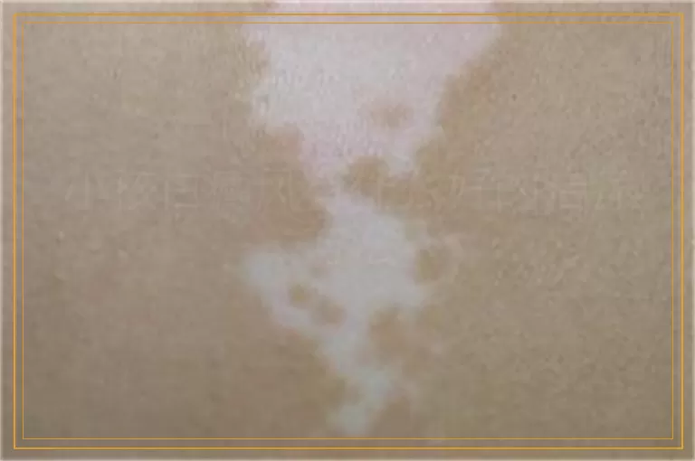 小孩白癜风有什么好的治疗方法