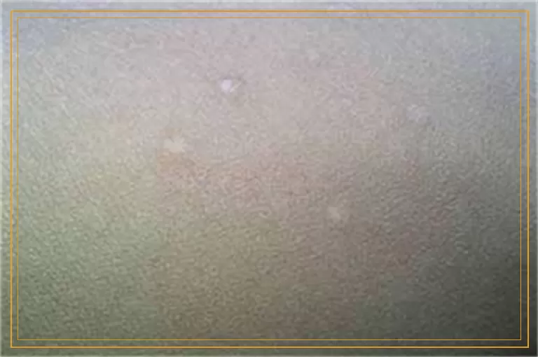 医院用来检测是不是白癜风的灯是什么