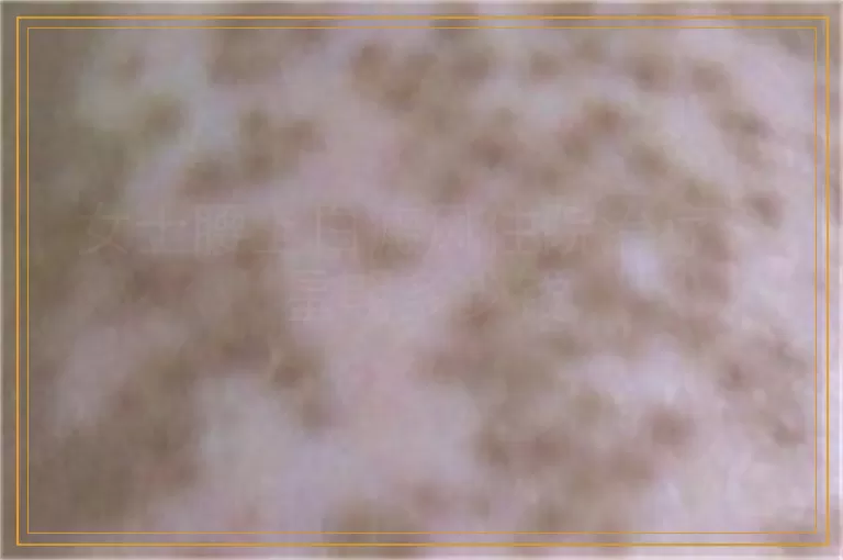 女士腰上白癜风住院治疗一星期多少钱