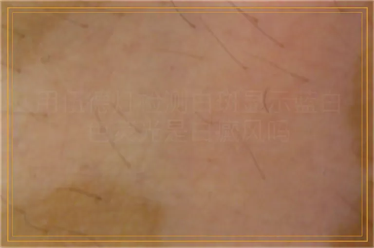 用伍德灯检测白斑显示蓝白色荧光是白癜风吗