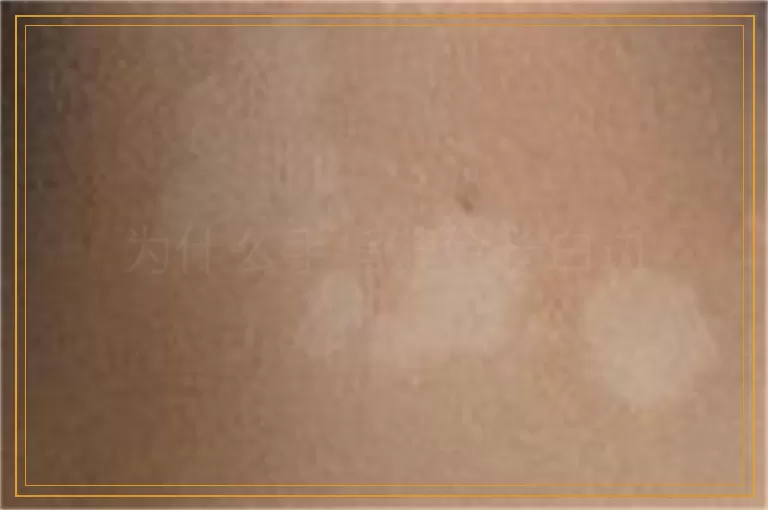 为什么手指缝会长白斑