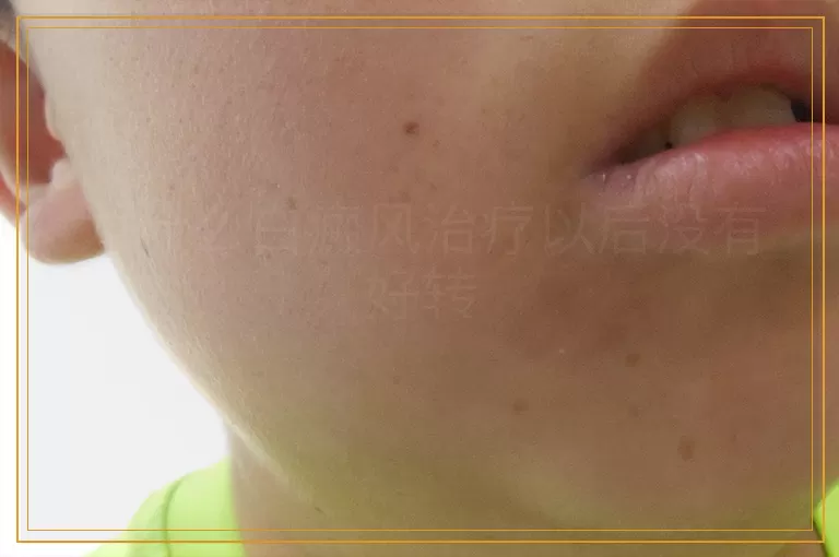 为什么白癜风治疗以后没有好转