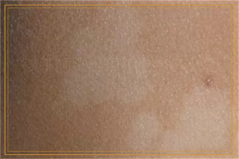 孩子额头出现小白点怎么回事