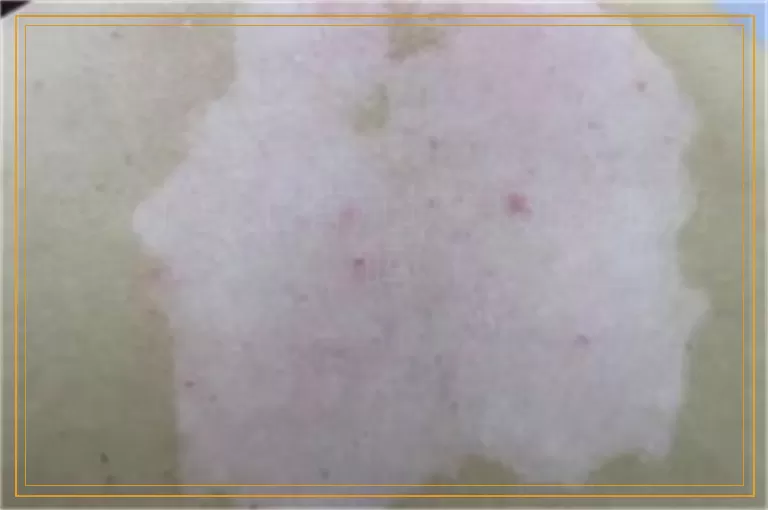 6岁了身上有几块白斑能瞧好吗