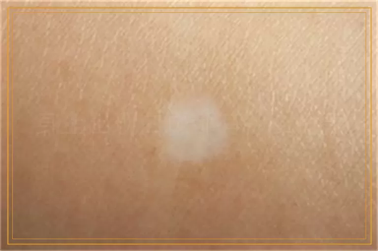 身上出现白斑都有什么危害