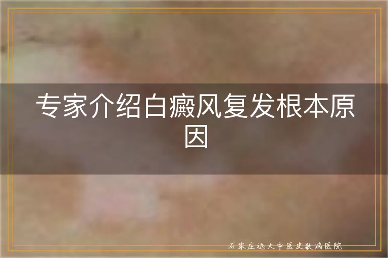 专家介绍白癜风复发根本原因