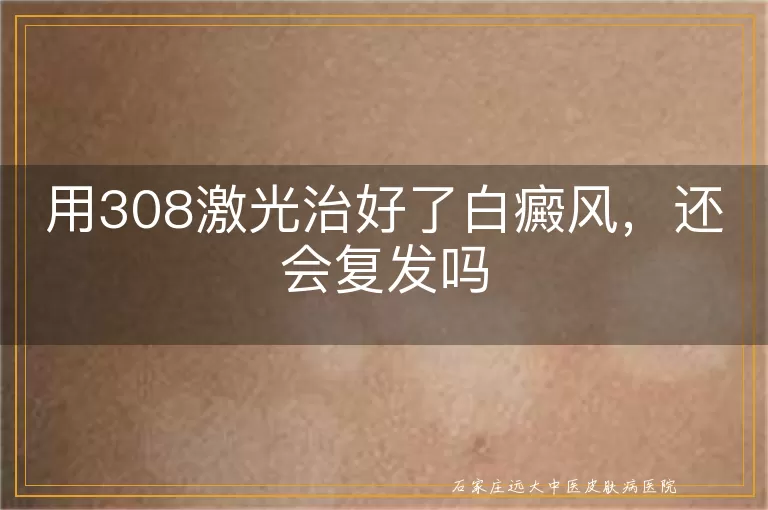 用308激光治好了白癜风，还会复发吗