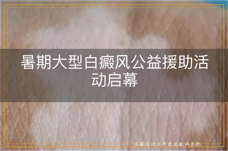 暑期大型白癜风公益援助活动启幕