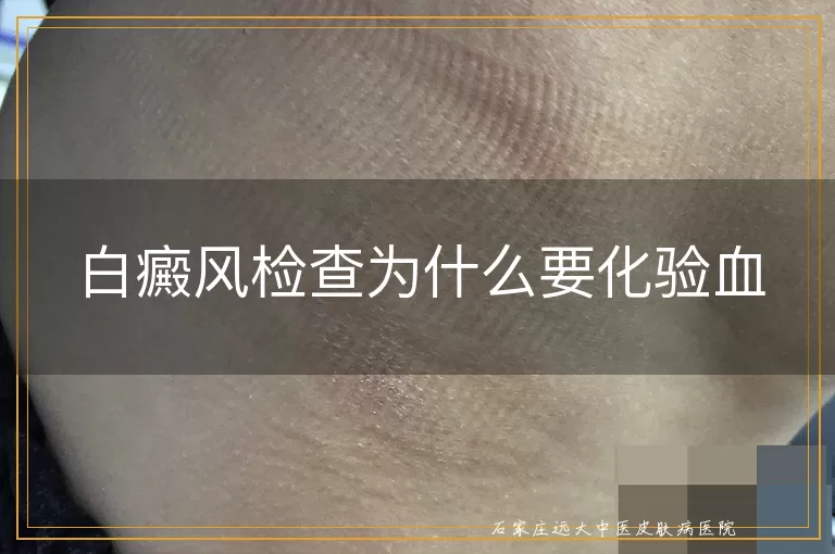 白癜风检查为什么要化验血
