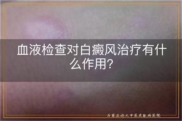 血液检查对白癜风治疗有什么作用？