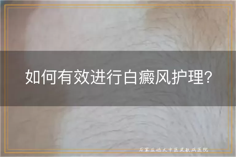 如何有效进行白癜风护理?