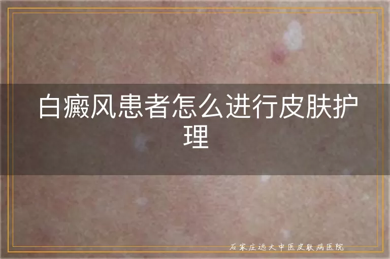 白癜风患者怎么进行皮肤护理